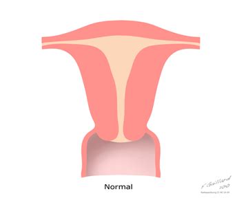 Uterine Pathologies Flashcards Quizlet