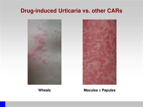 Ppt Drug Induced Urticaria Powerpoint Presentation Free Download Id 4932291