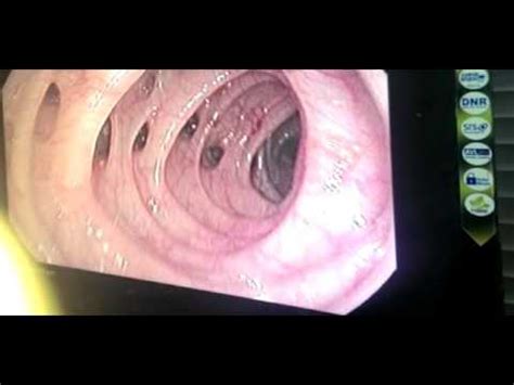 colonoscopy : diverticulosis coli - YouTube