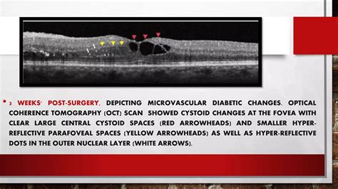 Diabetic cataract | PPT