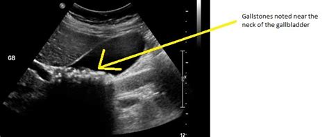 Diagnosing Gallstones Harmonic Medical Sonography Harmonic Medical