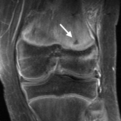 Hematogenous Osteomyelitis In Infants And Children Imaging Of A