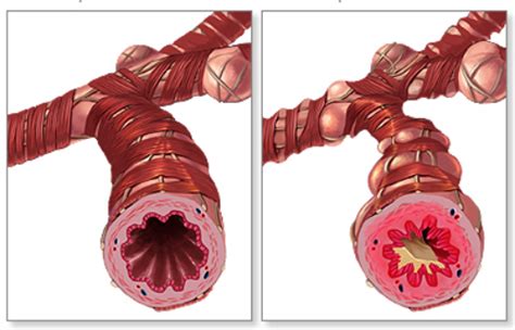 Breath Diseases: Asthma + COPD