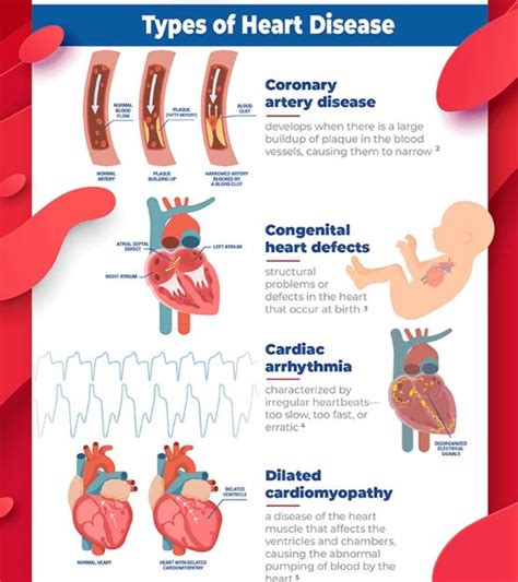 Infographic Types And Causes Of Heart Disease Doctors Without