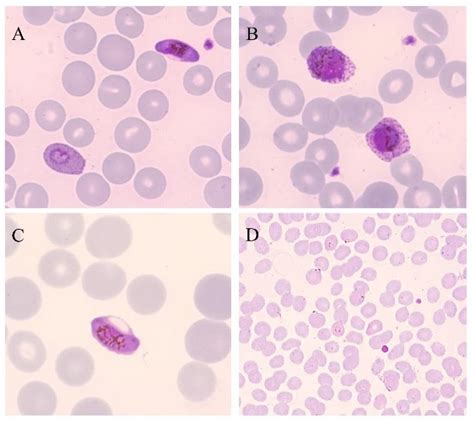 Plasmodium Falciparum Slide