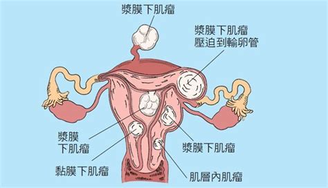 子宮肌瘤症狀出現經痛不單純！會影響懷孕？要手術嗎？ 康健雜誌