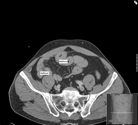 CT Scan Showing Most Of The Small Bowel On The Right Side Of The