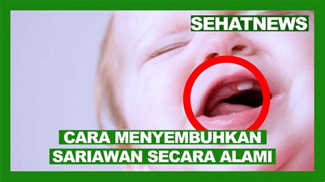 Cara Menyembuhkan Sariawan Di Lidah Dengan Cepat Dan Alami Youtube