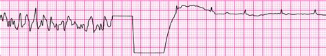 VF with Successful defibrillation and Resumption of Organized rhythm ...