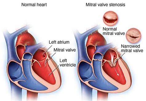 Pathophysiology Of Mitral Valve