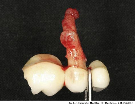 Granulation Tissue Tooth Extraction