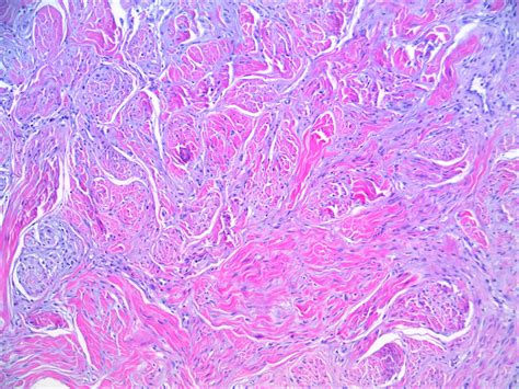 Desmoplastic melanoma – Blog | PathologyOutlines.com