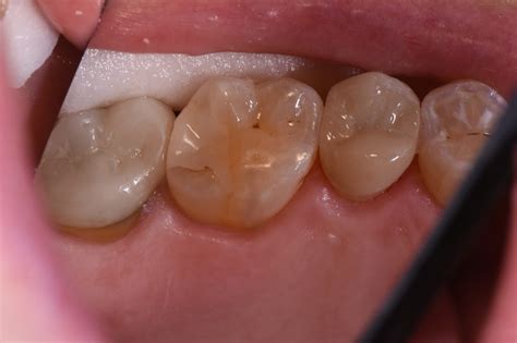 How Long For Dental Crown Cement To Set At Virginia Mata Blog