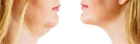 fat dissolving skin clinic windsor berkshire  london harley