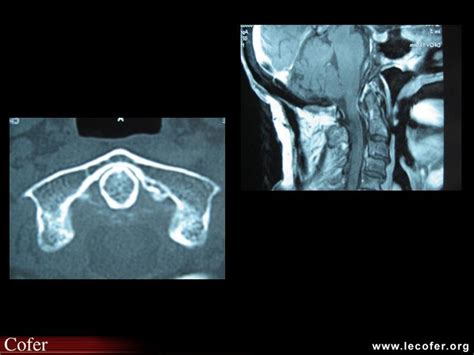 Arthrite Microcristalline Chondrocalcinose Syndrome De La Dent