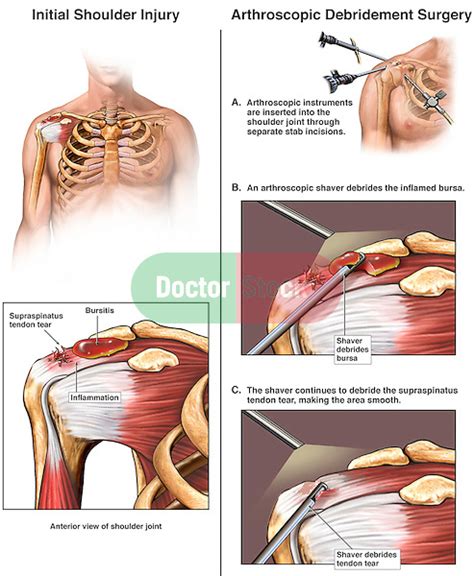 Torn Rotator Cuff Ligaments With Arthroscopic Debridement Surgery