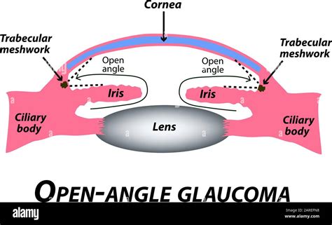 Glaucome Angle Ouvert Un Type Commun De Glaucome Structure