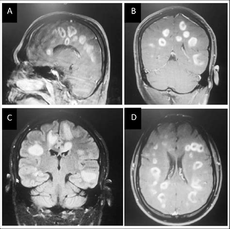 Contrast Enhanced Mri T1 Weighted Images Showing Multiple Ring