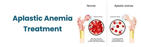 Treatment for Aplastic Anemia at Medicover Hospitals, Begumpet