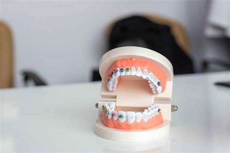 The Pros And Cons Of Different Types Of Orthodontic Treatment Life