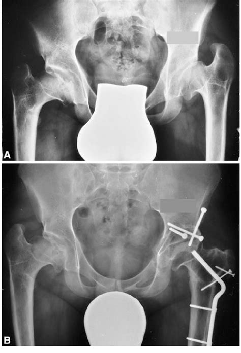 A B A This Ap Pelvic Radiograph Shows Bilateral Sequelae Of Perthes Download Scientific