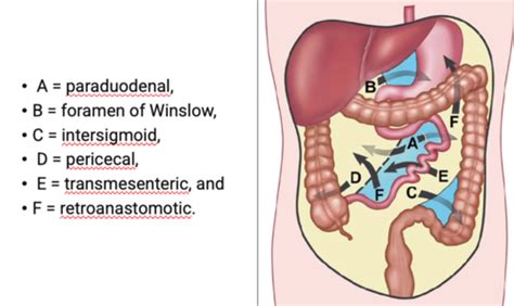 Clinical 23 24 Bowel Obstruction And Mesenteric Ischemia Flashcards