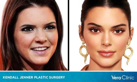 Kendall Jenner Plastic Surgery Journey Exploring The Rumors And Realities