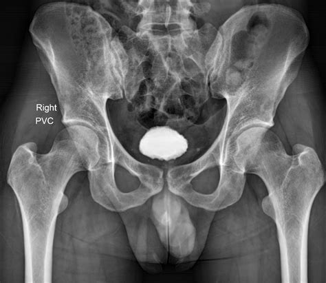 Urethral Stricture Image Radiopaedia Org