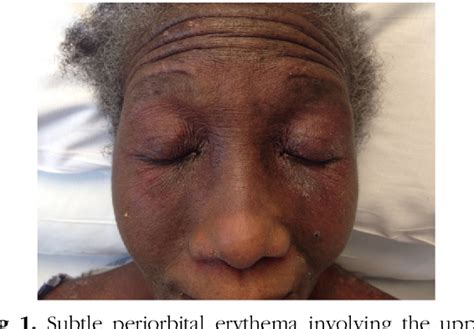 Figure 1 From Distinctive Cutaneous Features Of Dermatomyositis In