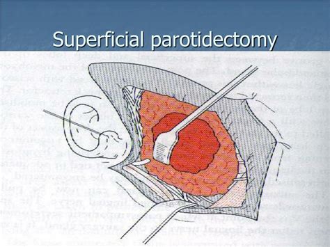 Parotidectomy Anatomy