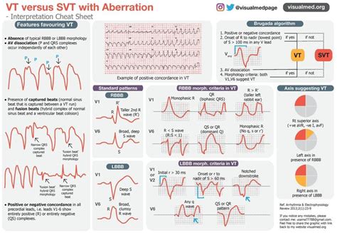 VT Versus SVT With Aberration Interpretation Cheat Charting For