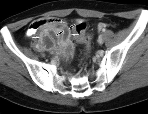 Unusual Causes Of Tubo Ovarian Abscess Ct And Mr Imaging Findings Radiographics