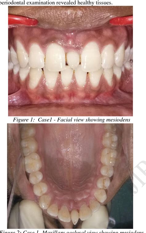 Figure 4 From Mesiodens A Report Of Two Cases Semantic Scholar