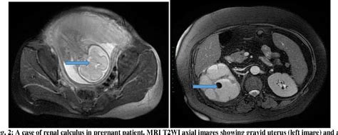 Figure 2 From Assessment Of Hydronephrosis In Obstetrics And