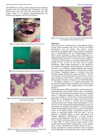 Giant cell fibroma