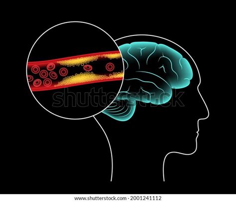 Ischemic Brain Stroke Arteriosclerosis Infarct Tia Stock Vector