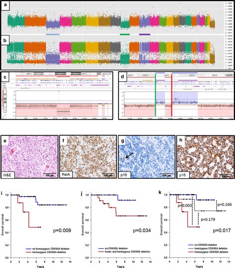 A Genomic Copy Number Profile And B Allele Distribution Mip Of A