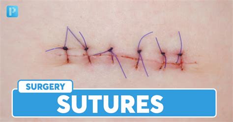 Sutures: Types, Stitches, Techniques and Removal