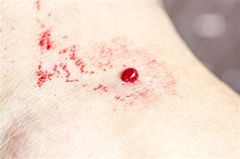 Blood on the wound. stock image. Image of bleed, human - 32606507