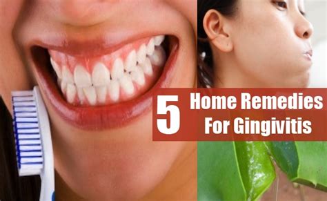 5 Gingivitis Home Remedies Natural Treatments And Cure