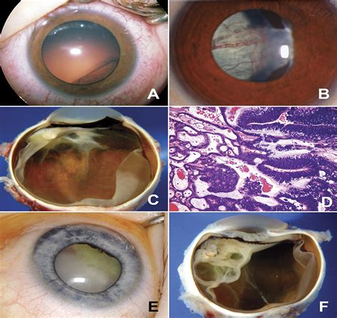 Tumors Of The Nonpigmented Epithelium Of The Ciliary Body T Retina