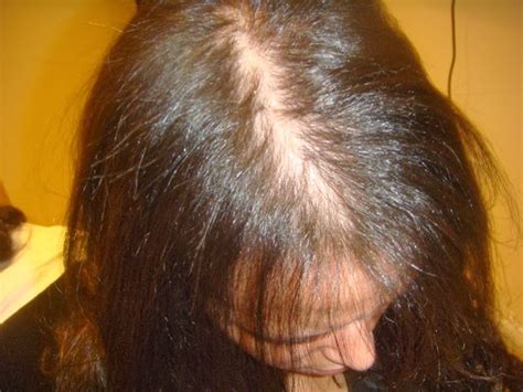 Treatment For Female Pattern Baldness (Options That Work ...