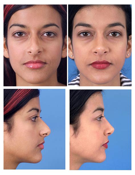 Rhinoplasty Before And After Photos