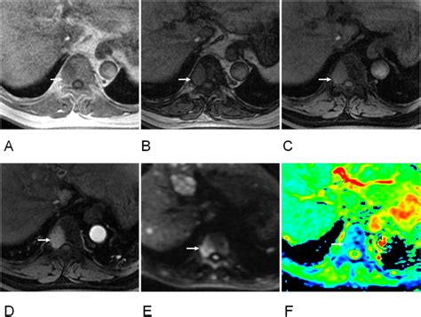 63 Year Old Women Of Hepatocellular Cell Carcinoma With Metastasis Of Download Scientific