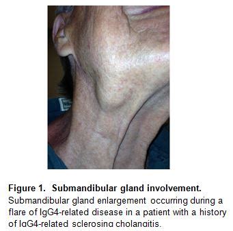 Extra-Pancreatic Features of Autoimmune Pancreatitis (IgG4-Related ...