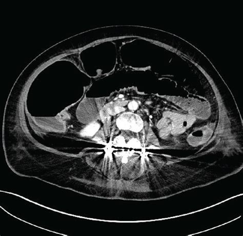 Pre And Postoperative Abdominal Ct Scan A Dilation Of Multiple