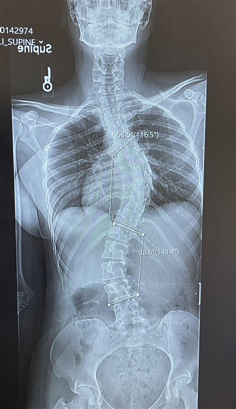1235 best Spinal images on Pholder | Spinalfusion, Scoliosis and Backpain
