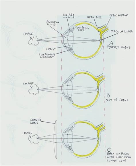 Long-sightedness, Farsightedness, hyperopia or hypermetropia. The Basics.