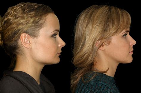 Orthognathic Facial Asymmetry Correction Corrective Jaw Surgery Dr