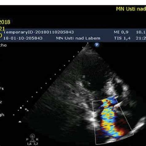 Echocardiography Showing Hypokinesis Of The Apex With Hyperkinesis Of Download Scientific